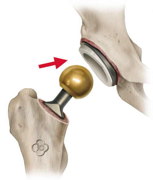 Hip Replacement treatment