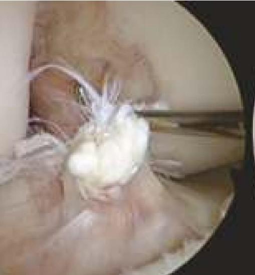 ACL surgery in bangalore ACL surgery in bangalore