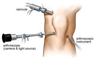 Arthroscopy doctors in Bangalore Arthroscopy doctors in Bangalore