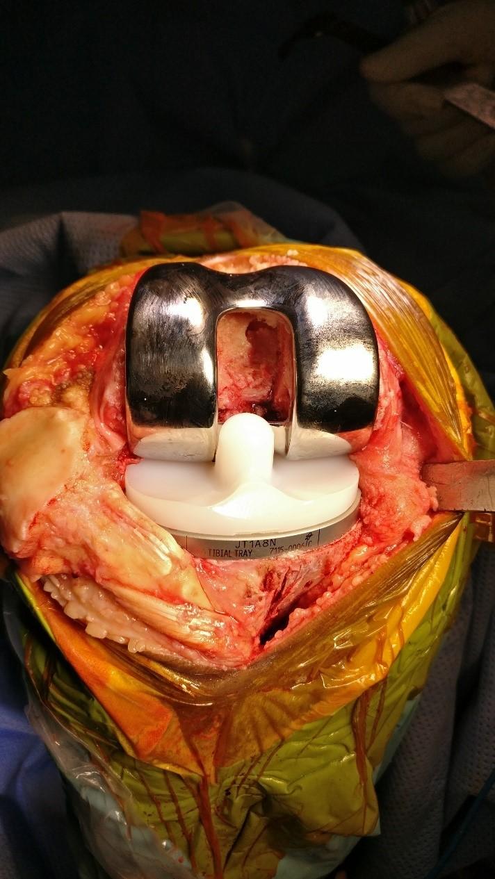Joint articulating surface Components of Joint Replacement Surgery