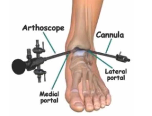 arthroscopy arthroscopy