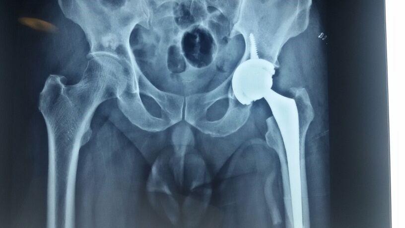 Advantages of Hip Replacement Surgery Advantages of Hip Replacement Surgery