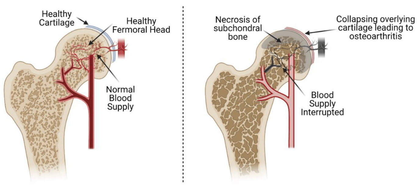 arthritis arthritis