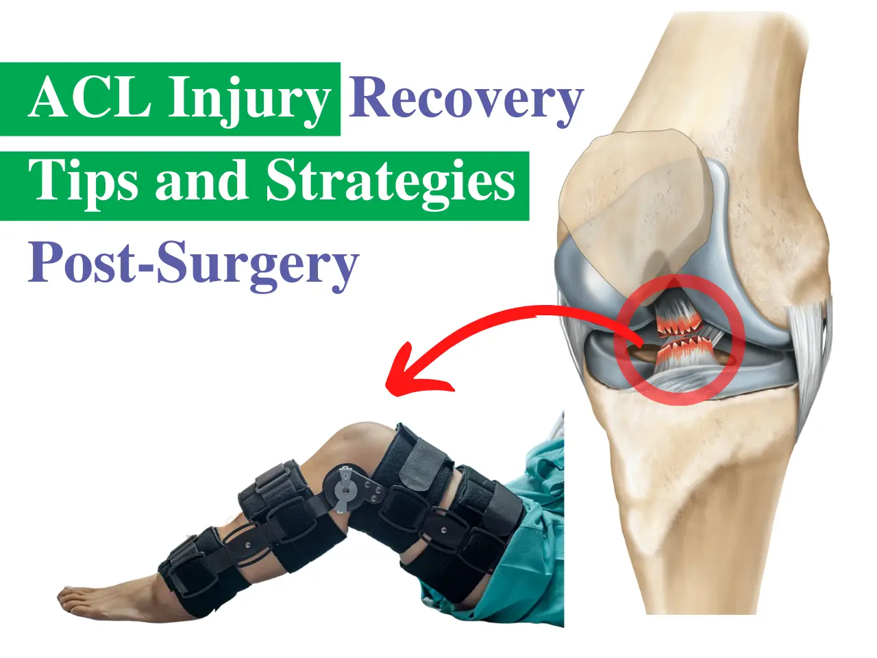 ACL Injury Recovery ACL Injury Recovery tips