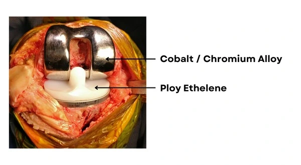 Knee-Joint-Replacement-