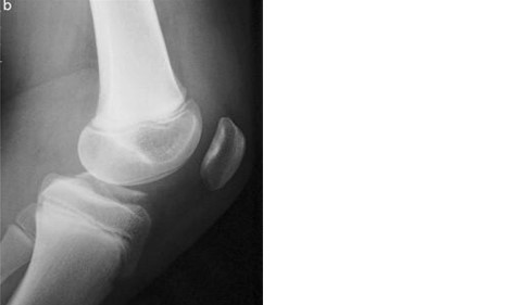 ACL Injury in Kids ACL Injury in Kids