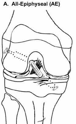 All-Epiphyseal (AE) All-Epiphyseal (AE)