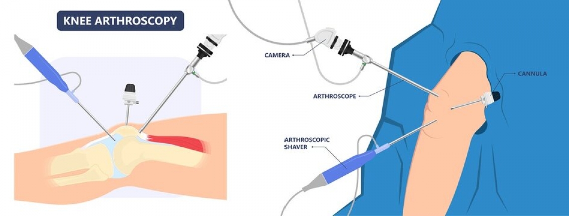 Knee Arthroscopy treatment Knee Arthroscopy treatment