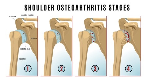 Shoulder osteoarthritis stages Shoulder osteoarthritis stages