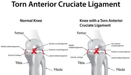 Torn Anterior Cruciate Ligament Torn Anterior Cruciate Ligament