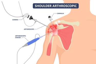 shoulder arthroscopy shoulder arthroscopy
