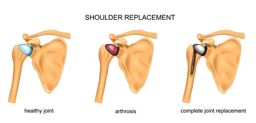 shoulder replacement shoulder replacement