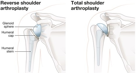 total shoulder arthroplasty total shoulder arthroplasty