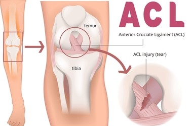 ACL Injury ACL Injury