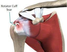 Rotator Cuff Tear Rotator Cuff Tear