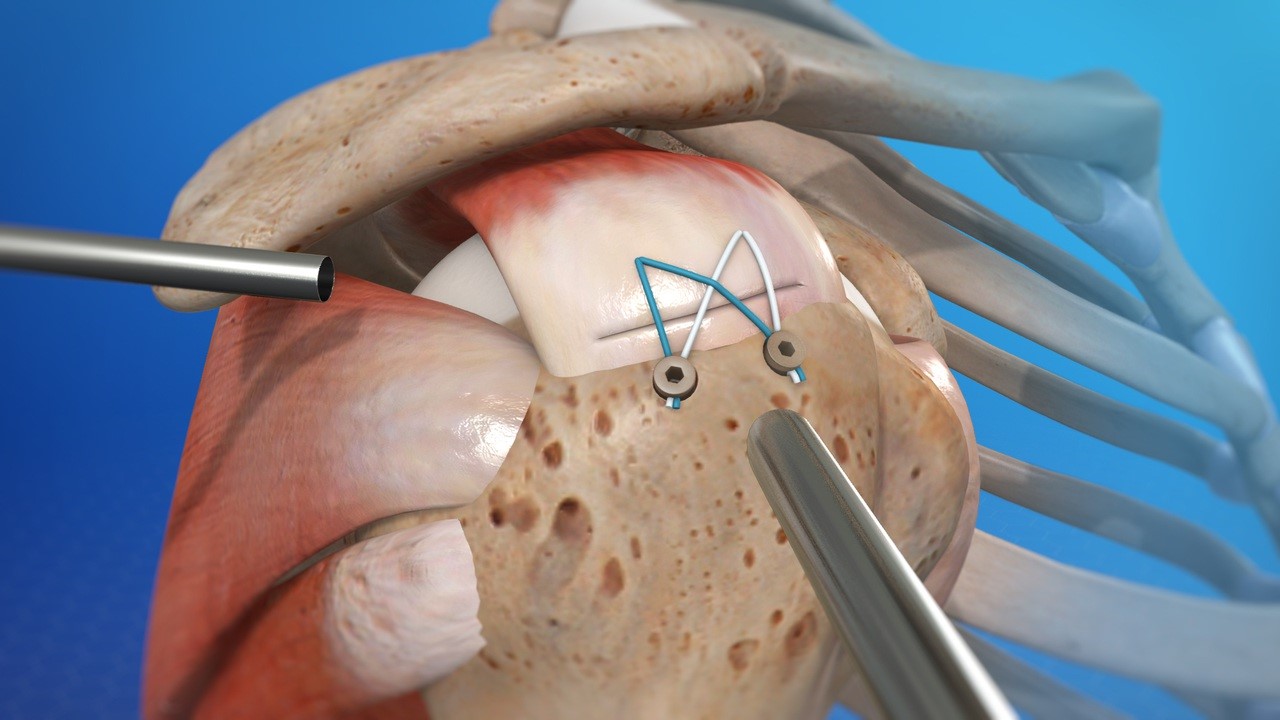 Surgical Intervention Surgical Intervention