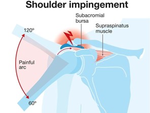 Shoulder impingement Shoulder impingement