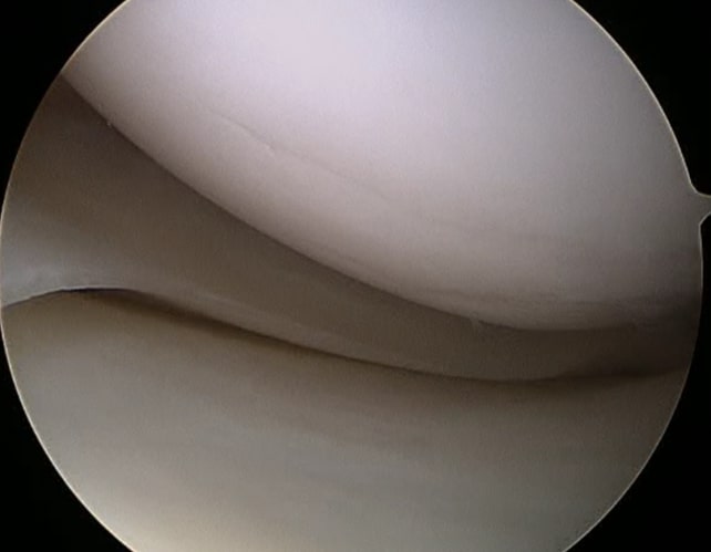 Meniscus Tears Meniscus Tears