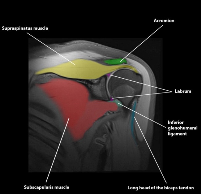 Role of MRI in Shoulder Joint Role of MRI in Shoulder Joint
