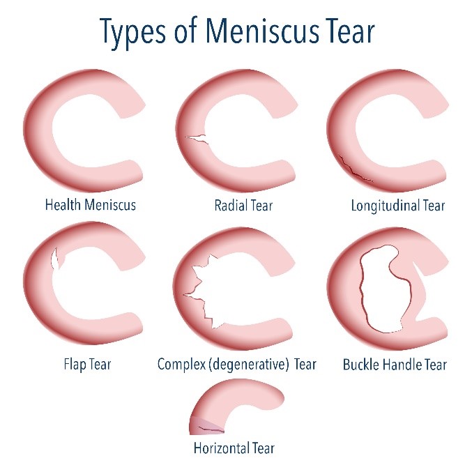 Types of Meniscus Tear Types of Meniscus Tear