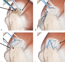 arthroscopic repair arthroscopic repair